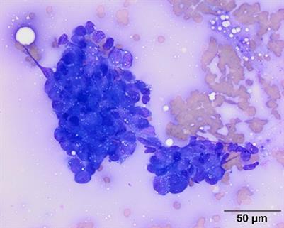Case report: Severe, refractory hypoglycemia in a 9-year-old Brittany Spaniel with renal nephroblastoma